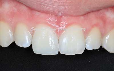 Tooth Coloured Filling After Trauma