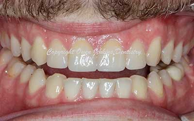 Gum Surgery for Crown Lengthening and Veneers