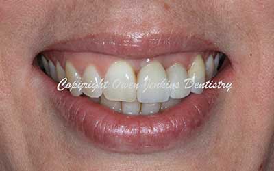 Orthodontics, Gum Surgery for Crown Lenghthening, Implant and Crowns