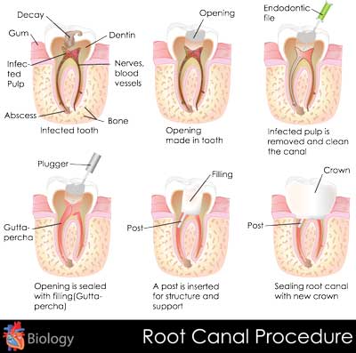 Dental Centre Maroochydore - Root Canal Treatment