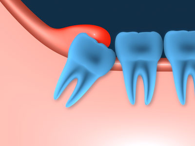 Dental Centre Maroochydore - Wisdom Teeth