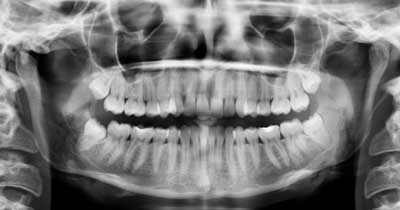 Dental Centre Maroochydore - X-Rays